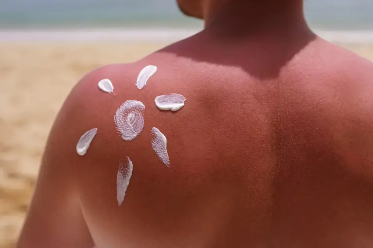Как да спрете беленето на кожата при слънчево изгаряне